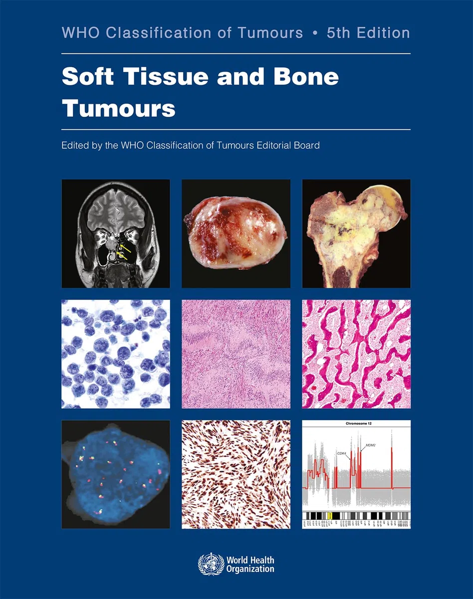 Soft Tissue and Bone Tumours: Who Classification of Tumours: 3